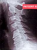 patient A.