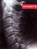 patient B.